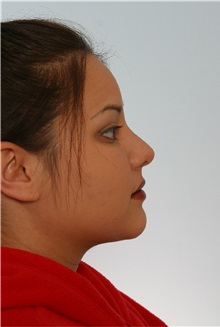 Rhinoplasty After Photo by Paul Vitenas, Jr., MD; Houston, TX - Case 50105