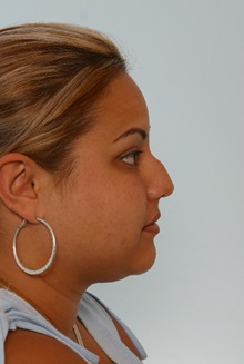 Rhinoplasty Before Photo by Paul Vitenas, Jr., MD; Houston, TX - Case 50105