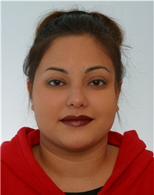 Rhinoplasty After Photo by Paul Vitenas, Jr., MD; Houston, TX - Case 50105
