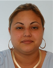 Rhinoplasty Before Photo by Paul Vitenas, Jr., MD; Houston, TX - Case 50105