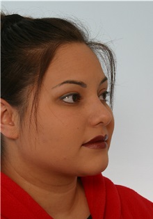 Rhinoplasty After Photo by Paul Vitenas, Jr., MD; Houston, TX - Case 50105