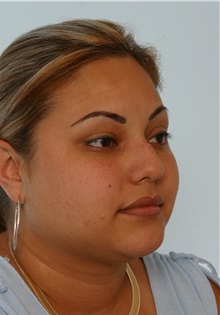 Rhinoplasty Before Photo by Paul Vitenas, Jr., MD; Houston, TX - Case 50105