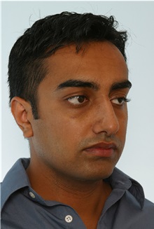 Rhinoplasty After Photo by Paul Vitenas, Jr., MD; Houston, TX - Case 50107