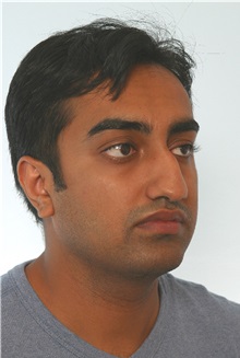 Rhinoplasty Before Photo by Paul Vitenas, Jr., MD; Houston, TX - Case 50107