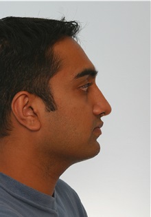 Rhinoplasty After Photo by Paul Vitenas, Jr., MD; Houston, TX - Case 50107