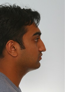 Rhinoplasty Before Photo by Paul Vitenas, Jr., MD; Houston, TX - Case 50107
