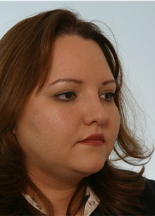 Rhinoplasty After Photo by Paul Vitenas, Jr., MD; Houston, TX - Case 50108