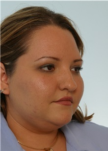Rhinoplasty Before Photo by Paul Vitenas, Jr., MD; Houston, TX - Case 50108