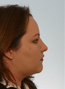 Rhinoplasty After Photo by Paul Vitenas, Jr., MD; Houston, TX - Case 50108