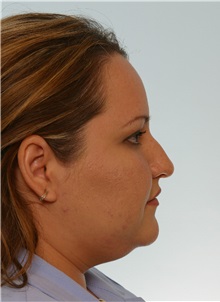 Rhinoplasty Before Photo by Paul Vitenas, Jr., MD; Houston, TX - Case 50108