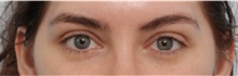 Eyelid Surgery After Photo by Paul Vitenas, Jr., MD; Houston, TX - Case 50109