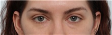 Eyelid Surgery Before Photo by Paul Vitenas, Jr., MD; Houston, TX - Case 50109