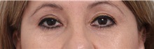 Eyelid Surgery After Photo by Paul Vitenas, Jr., MD; Houston, TX - Case 50112