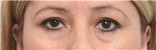Eyelid Surgery Before Photo by Paul Vitenas, Jr., MD; Houston, TX - Case 50112
