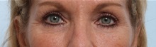 Eyelid Surgery After Photo by Paul Vitenas, Jr., MD; Houston, TX - Case 50114