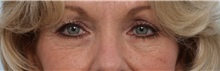 Eyelid Surgery Before Photo by Paul Vitenas, Jr., MD; Houston, TX - Case 50114
