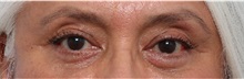 Eyelid Surgery After Photo by Paul Vitenas, Jr., MD; Houston, TX - Case 50110