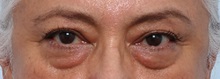 Eyelid Surgery Before Photo by Paul Vitenas, Jr., MD; Houston, TX - Case 50110