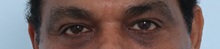 Eyelid Surgery After Photo by Paul Vitenas, Jr., MD; Houston, TX - Case 50111
