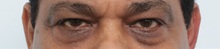 Eyelid Surgery Before Photo by Paul Vitenas, Jr., MD; Houston, TX - Case 50111