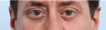 Eyelid Surgery After Photo by Paul Vitenas, Jr., MD; Houston, TX - Case 50116