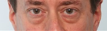 Eyelid Surgery Before Photo by Paul Vitenas, Jr., MD; Houston, TX - Case 50116