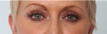 Eyelid Surgery After Photo by Paul Vitenas, Jr., MD; Houston, TX - Case 50113