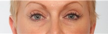 Eyelid Surgery Before Photo by Paul Vitenas, Jr., MD; Houston, TX - Case 50113