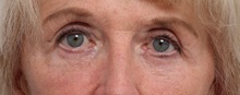 Eyelid Surgery After Photo by Paul Vitenas, Jr., MD; Houston, TX - Case 50118