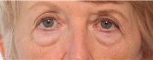 Eyelid Surgery Before Photo by Paul Vitenas, Jr., MD; Houston, TX - Case 50118