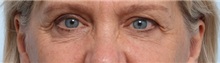 Eyelid Surgery Before Photo by Paul Vitenas, Jr., MD; Houston, TX - Case 50117