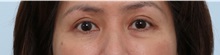 Eyelid Surgery After Photo by Paul Vitenas, Jr., MD; Houston, TX - Case 50115 Eyelid Surgery After Photo by Paul Vitenas, Jr., MD; Houston, TX - Case 50115