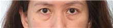 Eyelid Surgery Before Photo by Paul Vitenas, Jr., MD; Houston, TX - Case 50115 Eyelid Surgery Before Photo by Paul Vitenas, Jr., MD; Houston, TX - Case 50115