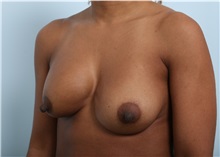 Breast Implant Revision Before Photo by Paul Vitenas, Jr., MD; Houston, TX - Case 50121
