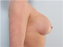 Breast Implant Revision Before Photo by Paul Vitenas, Jr., MD; Houston, TX - Case 50131