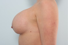 Breast Implant Revision Before Photo by Paul Vitenas, Jr., MD; Houston, TX - Case 50131