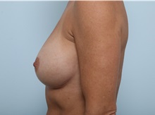 Breast Implant Revision After Photo by Paul Vitenas, Jr., MD; Houston, TX - Case 50136