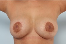 Breast Implant Revision After Photo by Paul Vitenas, Jr., MD; Houston, TX - Case 50135