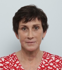 Facelift After Photo by Paul Vitenas, Jr., MD; ,  - Case 50216