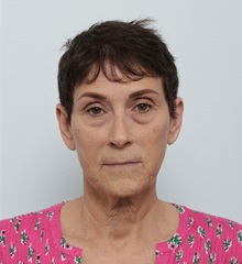 Facelift Before Photo by Paul Vitenas, Jr., MD; ,  - Case 50216