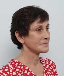 Facelift After Photo by Paul Vitenas, Jr., MD; ,  - Case 50216