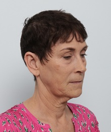 Facelift Before Photo by Paul Vitenas, Jr., MD; ,  - Case 50216