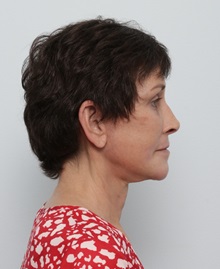 Facelift After Photo by Paul Vitenas, Jr., MD; ,  - Case 50216