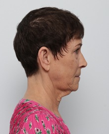 Facelift Before Photo by Paul Vitenas, Jr., MD; ,  - Case 50216