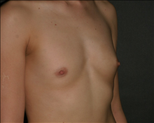 Breast Augmentation Before Photo by Otto Placik, MD, FACS; Arlington Heights, IL - Case 23574
