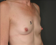 Breast Augmentation Before Photo by Otto Placik, MD, FACS; Arlington Heights, IL - Case 23610