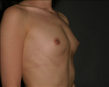 Breast Augmentation Before Photo by Otto Placik, MD, FACS; Arlington Heights, IL - Case 23620