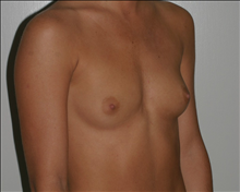 Breast Augmentation Before Photo by Otto Placik, MD, FACS; Arlington Heights, IL - Case 23627