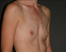 Breast Augmentation Before Photo by Otto Placik, MD, FACS; Arlington Heights, IL - Case 23628
