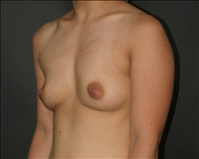Breast Augmentation Before Photo by Otto Placik, MD, FACS; Arlington Heights, IL - Case 23631